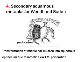 4. Secondary squamous
metaplasia( Wendt and Sade )
Transformation of middle ear mucosa into squamous
epithelium due to infection via T.M. perforation
 