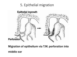 5. Epithelial migration
Migration of epithelium via T.M. perforation into
middle ear
 