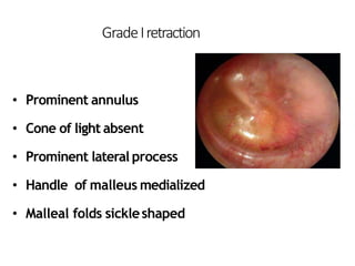 GradeIretraction
• Dull, lusterless T.M.
• Prominent annulus
• Cone of light absent
• Prominent lateral process
• Handle of malleus medialized
• Malleal folds sickleshaped
 