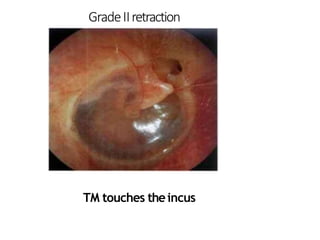 GradeIIretraction
TM touches theincus
 