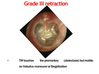 Grade III retraction
• TMtouches thepromontory (atelectasis) butmobile
onValsalva maneuverorSiegelization
 
