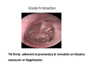 GradeIVretraction
TM firmly adherent to promontory & immobile onValsalva
maneuver or Siegelization
 