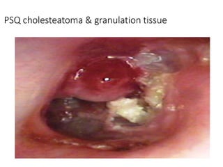 PSQ cholesteatoma & granulation tissue
 
