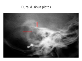 Dural & sinus plates
 