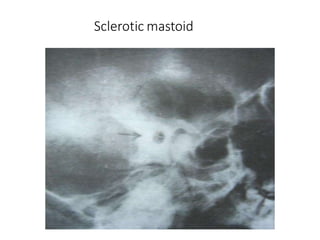 Sclerotic mastoid
 