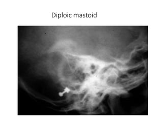 Diploic mastoid
 