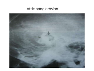 Attic bone erosion
 