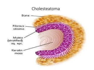 Cholesteatoma
 
