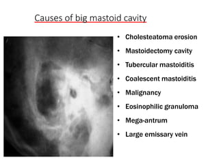 Causes of big mastoid cavity
• Cholesteatoma erosion
• Mastoidectomy cavity
• Tubercular mastoiditis
• Coalescent mastoiditis
• Malignancy
• Eosinophilic granuloma
• Mega-antrum
• Large emissary vein
 