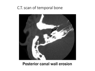 C.T. scan of temporal bone
Posterior canal wall erosion
 