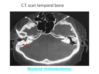 C.T. scan temporal bone
Mastoid cholesteatoma
 