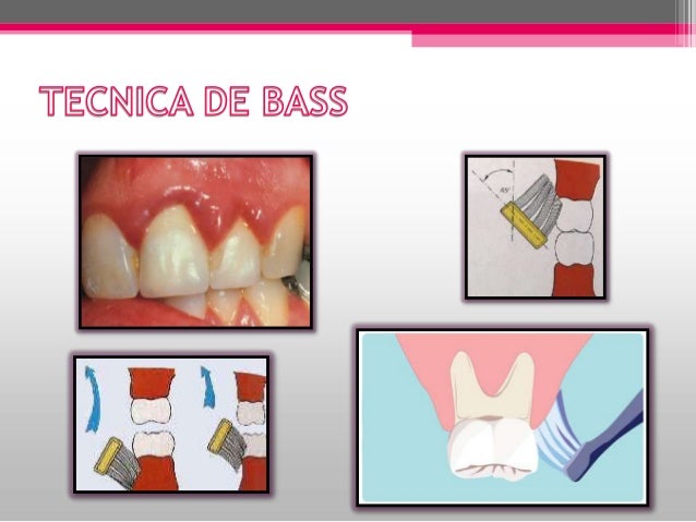 Resultado de imagen para tecnica de stillman
