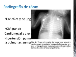 Radiografía de tórax 
CIV chica y de Roger es normal. 
CIV grande 
Cardiomegalia a expensa de ambos ventrículos 
Hipertensión pulmonar: Prominencia de cono de 
la pulmonar, aumento de trama pulmonar. 
 