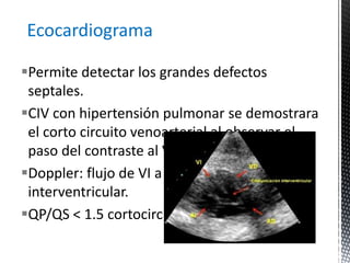 Ecocardiograma 
Permite detectar los grandes defectos 
septales. 
CIV con hipertensión pulmonar se demostrara 
el corto circuito venoarterial al observar el 
paso del contraste al VI 
Doppler: flujo de VI a VD por septum 
interventricular. 
QP/QS < 1.5 cortocircuito pequeño 
 