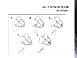 Comunicación interventricular