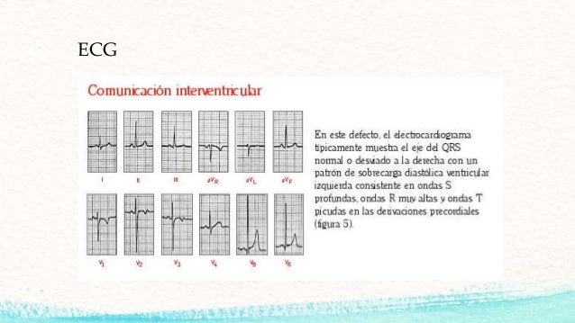 Comunicación interventricular
