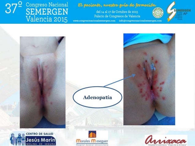 Sesion Clinica Comunicacion Oral Herpes Genital En Ninos