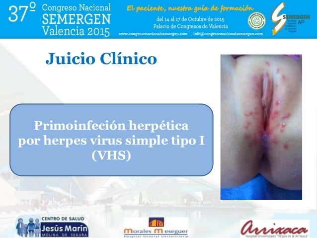 Sesion Clinica Comunicacion Oral Herpes Genital En Ninos