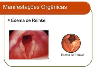 Edema de Reinke Manifestações Orgânicas Edema de Reinke 