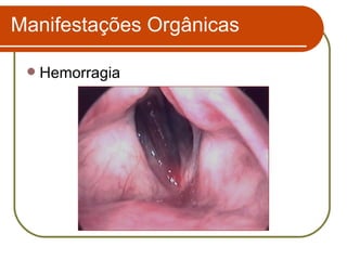 Hemorragia Manifestações Orgânicas 