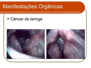 Câncer de laringe Manifestações Orgânicas 