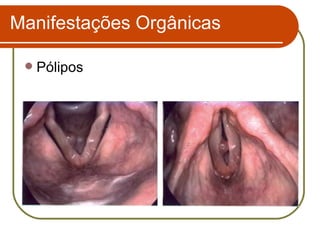 Pólipos Manifestações Orgânicas 
