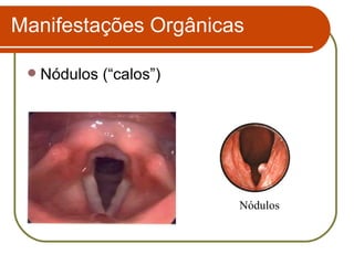 Nódulos (“calos”) Manifestações Orgânicas Nódulos 