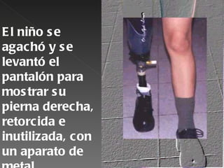 E l niño s e
agachó y s e
levantó el
pantalón para
mos trar s u
pierna derecha,
retorcida e
inutilizada, con
un aparato de
 