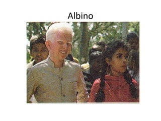 Albinismo
 