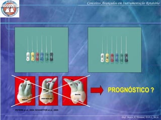 Prof. Marco A. Versiani, D.D.S., M.Sc.
Conceitos Avançados em Instrumentação Rotatória
PROGNÓSTICO ?PROGNÓSTICO ?
PETERS et al., 2004; SCHAEFFER et al., 2005
 