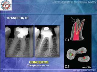 Prof. Marco A. Versiani, D.D.S., M.Sc.
Conceitos Avançados em Instrumentação Rotatória
PETERS, 2004
TRANSPORTE
CONCEITOS
Transporte (PETERS, 2004)
CONCEITOS
Transporte (PETERS, 2004)
 