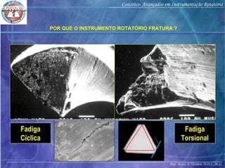 Prof. Marco A. Versiani, D.D.S., M.Sc.
Conceitos Avançados em Instrumentação Rotatória
POR QUE O INSTRUMENTO ROTATÓRIO FRATURA ?
Fadiga
Cíclica
Fadiga
Torsional
 