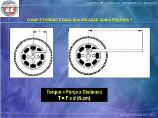 Prof. Marco A. Versiani, D.D.S., M.Sc.
Conceitos Avançados em Instrumentação Rotatória
O QUE É TORQUE E QUAL SUA RELAÇÃO COM A FRATURA ?
Torque = Força x Distância
T = F x d (N.cm)
 