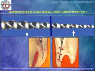 Prof. Marco A. Versiani, D.D.S., M.Sc.
Conceitos Avançados em Instrumentação Rotatória
USANDO MOTORES DE ÚLTIMA GERAÇÃO, AINDA HÁ RISCO DE FRATURA ?
 