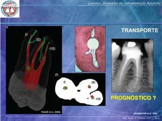 Prof. Marco A. Versiani, D.D.S., M.Sc.
Conceitos Avançados em Instrumentação Rotatória
SCHAEFFER et al., 2005
TRANSPORTE
PROGNÓSTICO ?PROGNÓSTICO ?
PAQUÉ et al., 2005b
 