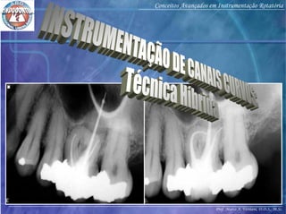Prof. Marco A. Versiani, D.D.S., M.Sc.
Conceitos Avançados em Instrumentação Rotatória
 