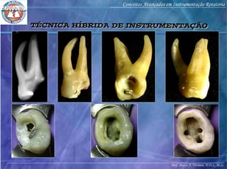 Prof. Marco A. Versiani, D.D.S., M.Sc.
Conceitos Avançados em Instrumentação Rotatória
TÉCNICA HÍBRIDA DE INSTRUMENTAÇÃOTÉCNICA HÍBRIDA DE INSTRUMENTAÇÃO
 