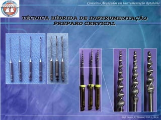 Prof. Marco A. Versiani, D.D.S., M.Sc.
Conceitos Avançados em Instrumentação Rotatória
TÉCNICA HÍBRIDA DE INSTRUMENTAÇÃO
PREPARO CERVICAL
TÉCNICA HÍBRIDA DE INSTRUMENTAÇÃO
PREPARO CERVICAL
 