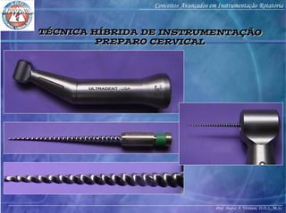 Prof. Marco A. Versiani, D.D.S., M.Sc.
Conceitos Avançados em Instrumentação Rotatória
TÉCNICA HÍBRIDA DE INSTRUMENTAÇÃO
PREPARO CERVICAL
TÉCNICA HÍBRIDA DE INSTRUMENTAÇÃO
PREPARO CERVICAL
 