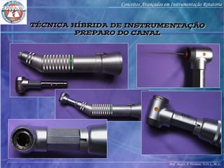 Prof. Marco A. Versiani, D.D.S., M.Sc.
Conceitos Avançados em Instrumentação Rotatória
TÉCNICA HÍBRIDA DE INSTRUMENTAÇÃO
PREPARO DO CANAL
TÉCNICA HÍBRIDA DE INSTRUMENTAÇÃO
PREPARO DO CANAL
 