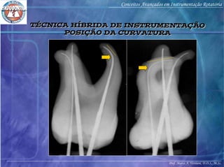 Prof. Marco A. Versiani, D.D.S., M.Sc.
Conceitos Avançados em Instrumentação Rotatória
TÉCNICA HÍBRIDA DE INSTRUMENTAÇÃO
POSIÇÃO DA CURVATURA
TÉCNICA HÍBRIDA DE INSTRUMENTAÇÃO
POSIÇÃO DA CURVATURA
 