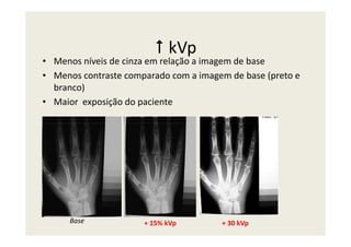 kVp
• Menos níveis de cinza em relação a imagem de base
• Menos contraste comparado com a imagem de base (preto e
branco)
• Maior exposição do paciente
+ 15% kVpBase + 30 kVp
 