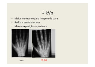 kVp
• Maior contraste que a imagem de base
• Reduz a escala de cinza
• Menor exposição do paciente
Base - 15 kvp
 