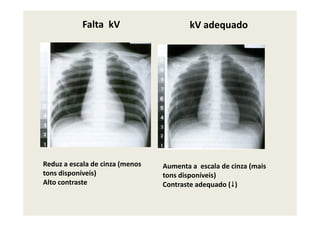 Falta kV kV adequado
Reduz a escala de cinza (menos
tons disponíveis)
Alto contraste
Aumenta a escala de cinza (mais
tons disponíveis)
Contraste adequado ( )
 