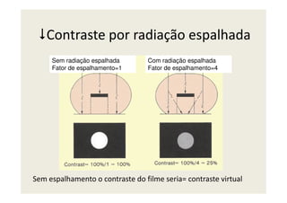 Contraste por radiação espalhada
Sem radiação espalhada
Fator de espalhamento=1
Com radiação espalhada
Fator de espalhamento=4
Sem espalhamento o contraste do filme seria= contraste virtual
 
