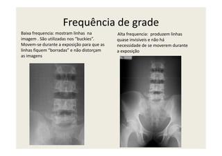 Frequência de grade
Alta frequencia: produzem linhas
quase invisíveis e não há
necessidade de se moverem durante
a exposição
Baixa frequencia: mostram linhas na
imagem . São utilizadas nos “buckies”.
Movem-se durante a exposição para que as
linhas fiquem “borradas” e não distorçam
as imagens
 