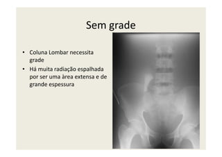Sem grade
• Coluna Lombar necessita
grade
• Há muita radiação espalhada
por ser uma àrea extensa e depor ser uma àrea extensa e de
grande espessura
 