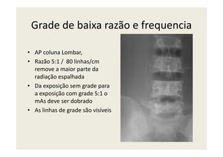 Grade de baixa razão e frequencia
• AP coluna Lombar,
• Razão 5:1 / 80 linhas/cm
remove a maior parte da
radiação espalhadaradiação espalhada
• Da exposição sem grade para
a exposição com grade 5:1 o
mAs deve ser dobrado
• As linhas de grade são visíveis
 