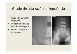 Grade de alta razão e frequência
• Razão 10:1 com 100
linhas /cm
• Práticamente não se
vê as linhas de gradevê as linhas de grade
• Requer radiação 5
vezes maior
 