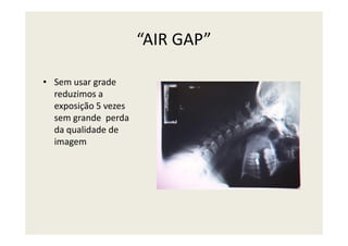“AIR GAP”
• Sem usar grade
reduzimos a
exposição 5 vezes
sem grande perda
da qualidade de
imagem
 